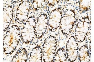 ABIN6261590 and ABIN6276833 at 1/100 staining Human colorectal cancer by IHC-P. (ERCC3 Antikörper  (N-Term))