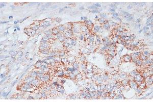 Immunohistochemistry of paraffin-embedded Human colon carcinoma using Desmoplakin Polyclonal Antibody at dilution of 1:100 (40x lens).