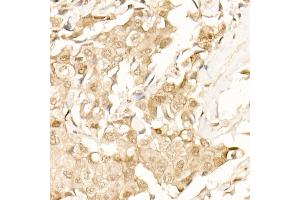 Immunohistochemistry of paraffin-embedded Human breast cancer using β-Catenin antibody (ABIN1684202, ABIN1512789, ABIN3020926 and ABIN3020928) at dilution of 25 (40x lens). (CTNNB1 Antikörper)