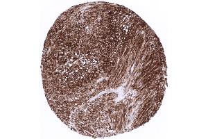 Gastrointestinal stromal tumor with strong CD34 expression (Rekombinanter CD34 Antikörper)