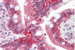 Immunohistochemistry (IHC) image for anti-Aldo-Keto Reductase Family 1, Member C3 (3-alpha Hydroxysteroid Dehydrogenase, Type II) (AKR1C3) (C-Term) antibody (ABIN185345)