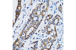 Immunohistochemistry of paraffin-embedded human colon carcinoma using STAT3 antibody (ABIN5998978) at dilution of 1/100 (40x lens). (STAT3 Antikörper)