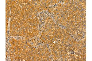 ABIN6265786 and ABIN6273022 at 1/100 staining Human lung cancer by IHC-P. (TTLL6 Antikörper  (N-Term))