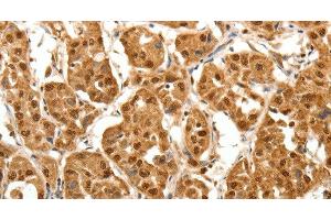 Immunohistochemistry of paraffin-embedded Human lung cancer tissue using TNN Polyclonal Antibody at dilution 1:40 (Tenascin N Antikörper)