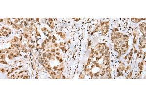 Immunohistochemistry of paraffin-embedded Human breast cancer tissue using ZNF486 Polyclonal Antibody at dilution of 1:50(x200) (ZNF486 Antikörper)