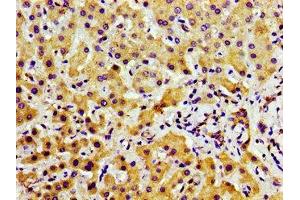 Immunohistochemistry of paraffin-embedded human liver cancer using ABIN7169191 at dilution of 1:100 (TAO Kinase 2 Antikörper  (AA 719-880))