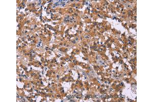 Immunohistochemistry of Human liver cancer using PIP5K1B Polyclonal Antibody at dilution of 1:30
