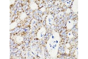 Immunohistochemistry of paraffin-embedded Human colon carcinoma using PDCD10 Polyclonal Antibody at dilution of 1:100 (40x lens).