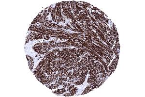 Uterus Leiomyosarcoma showing intense Caldesmon immunostaining of tumor cells Caldesmon immunohistochemistry (Rekombinanter Caldesmon Antikörper)