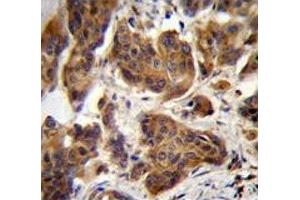 ZGRF1 antibody immunohistochemistry analysis in formalin fixed and paraffin embedded human bladder carcinoma. (ZGRF1 Antikörper  (AA 38-66))