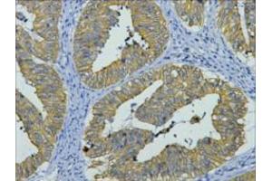 Immunohistochemistry (IHC) staining of Human Colon cancer tissue, diluted at 1:200. (KRT8 Antikörper)