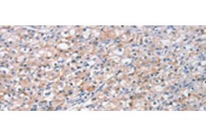 Immunohistochemistry of paraffin-embedded Human prost ate cancer tissue using STK16 Polyclonal Antibody at dilution of 1:30(x200)