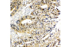 Anti-NME2 antibody, IHC(P) IHC(P): Human Intestinal Cancer Tissue