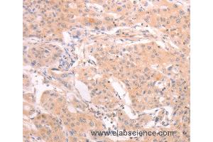Immunohistochemistry of Human lung cancer using INA Polyclonal Antibody at dilution of 1:25 (INA Antikörper)