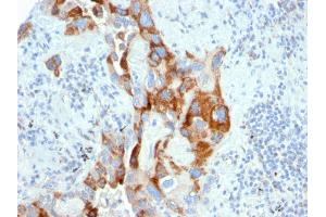 Formalin-fixed, paraffin-embedded human Colon Carcinoma stained with PMEPA1 Mouse Monoclonal Antibody (PMEPA1/2696). (PMEPA1 Antikörper)