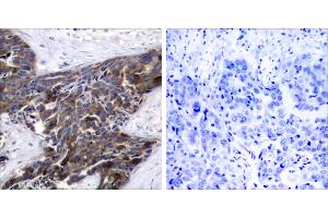 P-peptide - +Immunohistochemical analysis of paraffin-embedded human breast carcinoma tissue, using Connexin43 (Phospho-Ser367) antibody. (Connexin 43/GJA1 Antikörper  (pSer367))