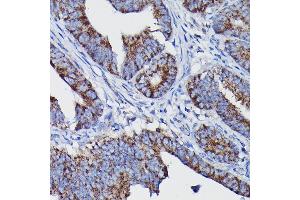 Immunohistochemistry of paraffin-embedded human colon carcinoma using Clusterin alpha chain Rabbit pAb (ABIN6133477, ABIN6138756, ABIN6138758 and ABIN6216721) at dilution of 1:100 (40x lens). (Clusterin Antikörper  (AA 23-120))