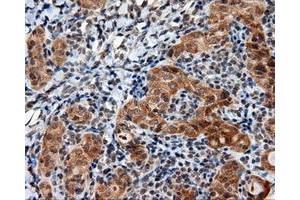 Immunohistochemical staining of paraffin-embedded Adenocarcinoma of ovary tissue using anti-LIPG mouse monoclonal antibody. (LIPG Antikörper)