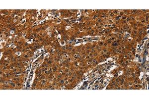 Immunohistochemistry of paraffin-embedded Human gastric cancer tissue using CATSPER4 Polyclonal Antibody at dilution 1:50 (CATSPER4 Antikörper)