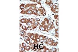 Formalin-fixed and paraffin-embedded human cancer tissue reacted with the primary antibody, which was peroxidase-conjugated to the secondary antibody, followed by DAB staining. (SIK1 Antikörper  (C-Term))