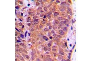 Immunohistochemical analysis of FOXO1 (pS319) staining in human breast cancer formalin fixed paraffin embedded tissue section.