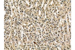 FER Mouse Monoclonal Antibody at 1/100 staining human gastric cancer by IHC-P. (FER Antikörper)