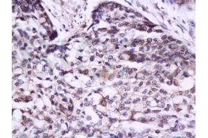 Formalin-fixed and paraffin embedded human esophagus carcinoma tissue labeled with Anti-IL-17/IL-17A Polyclonal Antibody, Unconjugated (ABIN738891) at 1:300 followed by conjugation to the secondary antibody and DAB staining (IL-17 Antikörper  (AA 85-150))