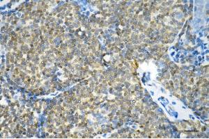 Immunohistochemistry was performed on paraffin-embedded human breast carcinoma using glutathione-disulfide reductase antibody (ABIN7798754), 1:200).