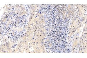 Detection of CDK4 in Human Lymphoma Tissue using Polyclonal Antibody to Cyclin Dependent Kinase 4 (CDK4) (CDK4 Antikörper  (AA 6-295))