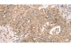 Immunohistochemistry of paraffin-embedded Human breast cancer using STX10 Polyclonal Antibody at dilution of 1:45 (Syntaxin 10 Antikörper)