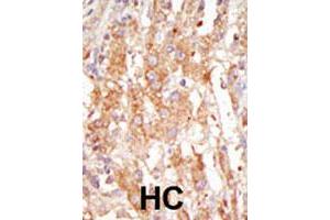 Formalin-fixed and paraffin-embedded human hepatocellular carcinoma tissue reacted with the MAP3K6 polyclonal antibody  , which was peroxidase-conjugated to the secondary antibody, followed by DAB staining. (MAP3K6 Antikörper  (C-Term))