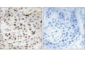 Immunohistochemistry analysis of paraffin-embedded human breast carcinoma, using HMG14 (Phospho-Ser21) Antibody. (HMGN1 Antikörper  (pSer21))