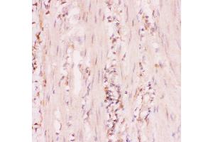 Anti-MRP4 Picoband antibody,  IHC(P): Human Intestinal Cancer Tissue (ABCC4 Antikörper  (AA 1-370))