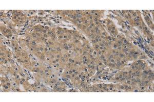 Immunohistochemistry of paraffin-embedded Human gastric cancer tissue using AGTRAP Polyclonal Antibody at dilution 1:40 (AGTRAP Antikörper)