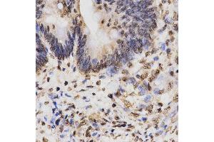 Immunohistochemistry of paraffin-embedded human rectal cancer tissue using H3K27me3 antibody at dilution of 1:200 (x400 lens). (Histone 3 Antikörper  (H3K27me))