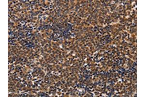 The image on the left is immunohistochemistry of paraffin-embedded Human lymphoma tissue using ABIN7128260(ADH1A Antibody) at dilution 1/20, on the right is treated with fusion protein. (ADH1A Antikörper)