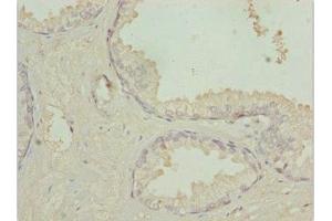 Immunohistochemistry of paraffin-embedded human prostate cancer using ABIN7172947 at dilution of 1:100 (TM9SF1 Antikörper  (AA 28-230))