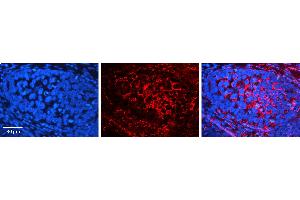 Rabbit Anti-VIM Antibody   Formalin Fixed Paraffin Embedded Tissue: Human Ovary Tissue Observed Staining: Cytoplasm Primary Antibody Concentration: 1:100 Other Working Concentrations: N/A Secondary Antibody: Donkey anti-Rabbit-Cy3 Secondary Antibody Concentration: 1:200 Magnification: 20X Exposure Time: 0.