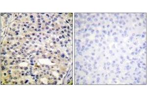 Immunohistochemistry analysis of paraffin-embedded human breast carcinoma, using Vimentin (Phospho-Ser56) Antibody. (Vimentin Antikörper  (pSer56))