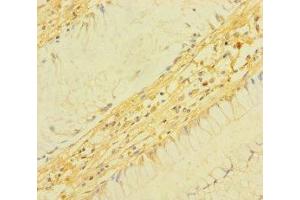 Immunohistochemistry of paraffin-embedded human colon cancer using ABIN7172934 at dilution of 1:100 (TM4SF5 Antikörper  (AA 112-157))