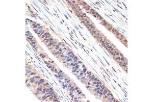 Immunohistochemistry of paraffin-embedded human colon carcinoma using sestrin 1 Rabbit mAb (ABIN7270259) at dilution of 1:100 (40x lens).