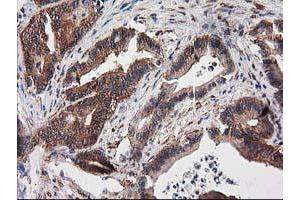 Immunohistochemical staining of paraffin-embedded Adenocarcinoma of Human colon tissue using anti-DSTN mouse monoclonal antibody.