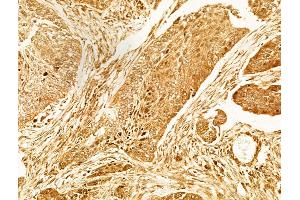 ABIN6263306 and ABIN6266597 at 1/100 staining Human lung cancer by IHC-P. (MMP7 Antikörper  (C-Term))