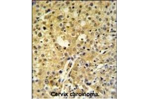 C2orf49 Antibody (N-term) (ABIN651382 and ABIN2840213) IHC analysis in formalin fixed and paraffin embedded human cervix carcinoma followed by peroxidase conjugation of the secondary antibody and DAB staining. (C2orf49 Antikörper  (N-Term))