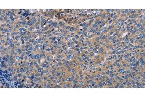 Immunohistochemistry of paraffin-embedded Human cervical cancer using INTS10 Polyclonal Antibody at dilution of 1:50 (INTS10 Antikörper)