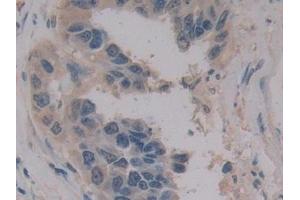 Detection of MPG1 in Human Breast cancer Tissue using Polyclonal Antibody to Macrophage Expressed Gene 1 Protein (MPG1) (MPEG1 Antikörper  (AA 313-580))