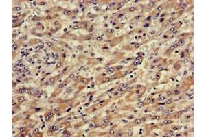 Immunohistochemistry of paraffin-embedded human liver cancer using ABIN7144881 at dilution of 1:100 (ABCA5 Antikörper  (AA 1230-1355))