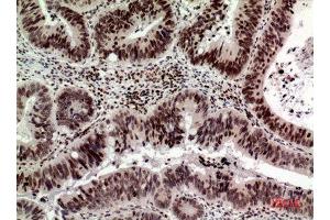 Immunohistochemistry (IHC) analysis of paraffin-embedded Human Colon Cancer, antibody was diluted at 1:100.