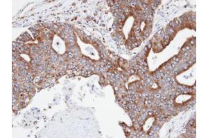IHC-P Image Immunohistochemical analysis of paraffin-embedded human endo mitral ovarian cancer, using CPNE3, antibody at 1:100 dilution. (Copine III Antikörper)