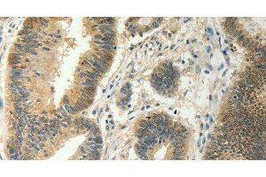 Immunohistochemistry of paraffin-embedded Human colon cancer tissue using SOCS5 Polyclonal Antibody at dilution 1:35
